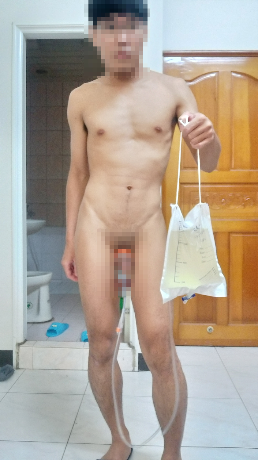 尿袋放尿一天擠回膀胱